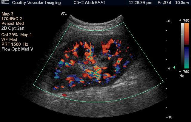 Quality Vascular Imaging-Renal Artery Duplex diagram of normal kidney 